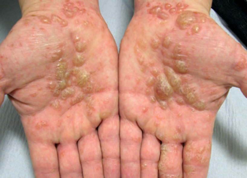 What I Tell My Patients About Hand Eczema Dermatology In Practice